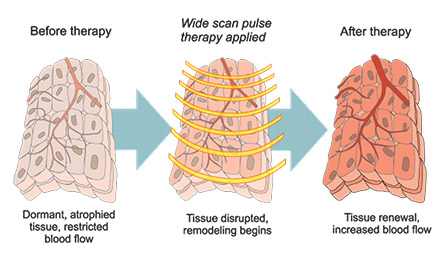 Effects of ErosWave Scan Pulse Therapy